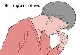 stopping Nosebleed